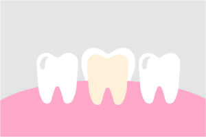 Image showing a dental crown sitting atop a damaged or decayed tooth. 