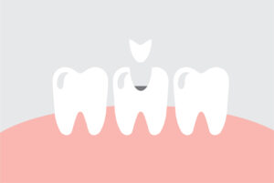 Image depicting a dental filling going into a cavity on a tooth. 