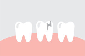 Image depicting a cracked tooth, which can be a dental emergency. 